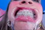 Braces , I Love messy